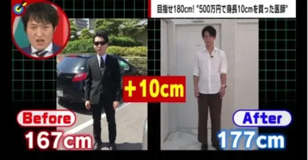 키 10cm 늘린 일본의사