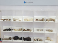 병원에 전시된 실제 환자들 몸에서 나온 담석들