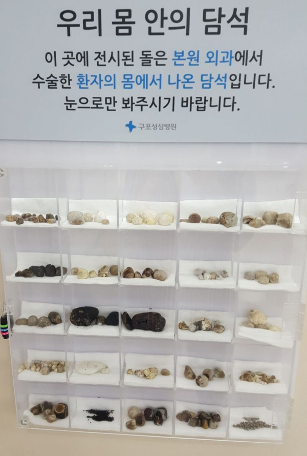병원에 전시된 실제 환자들 몸에서 나온 담석들