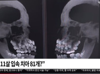 브라질 치아가 81개인 11살